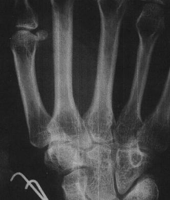 Xray